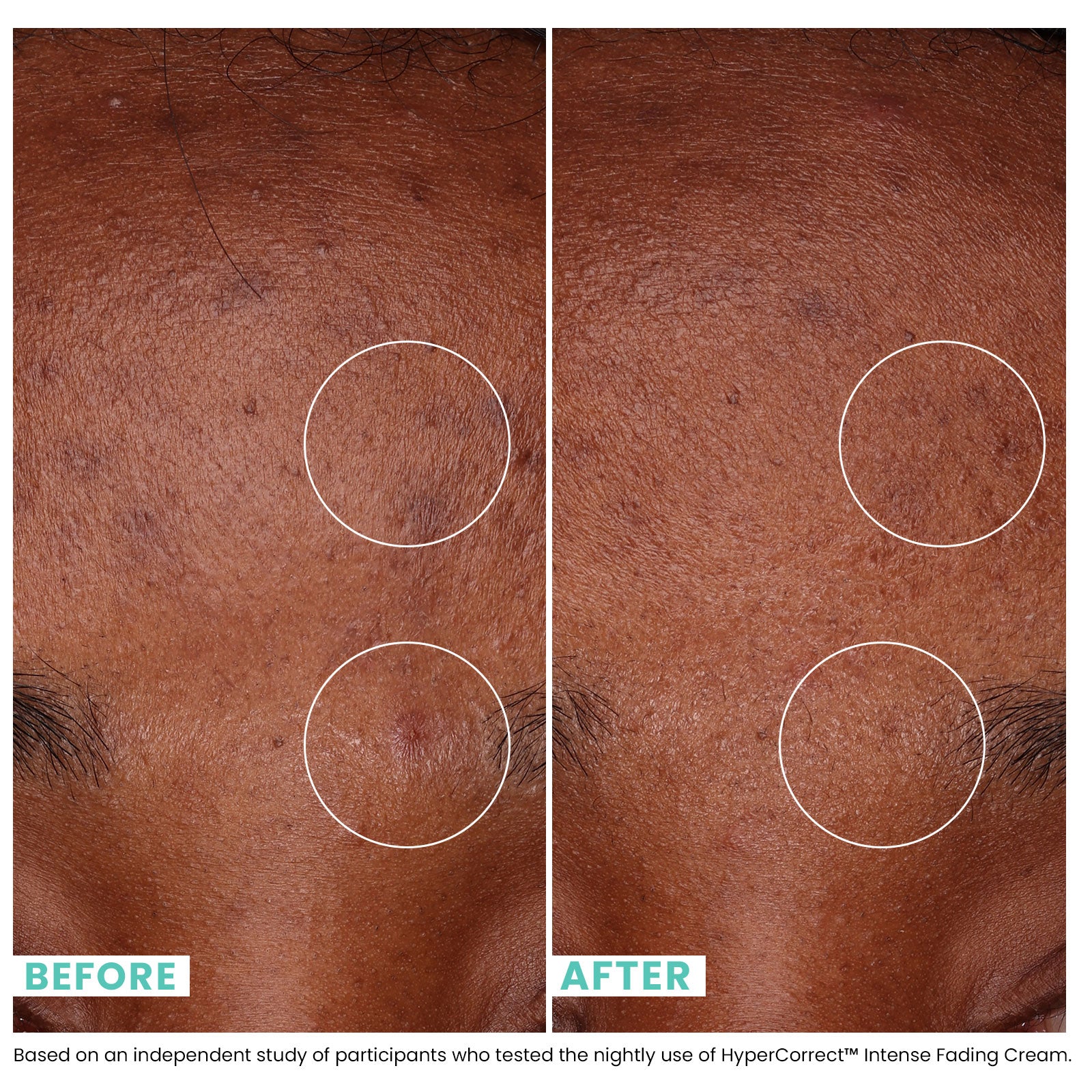 Woman's skin before and after Urban Skin RX HyperCorrect Intense Fading Cream with visibly improved skin