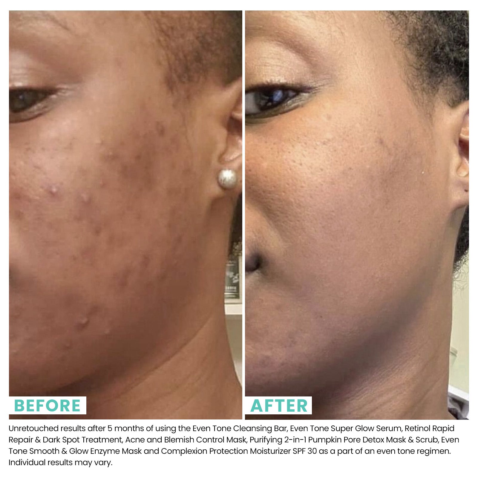 Blemish Mask: Acne and Acne Fighting | Urban Skin Rx