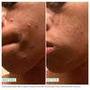 Woman's face before and after using USRX Clean Skin Cleansing Bar treatment for clarifying skin