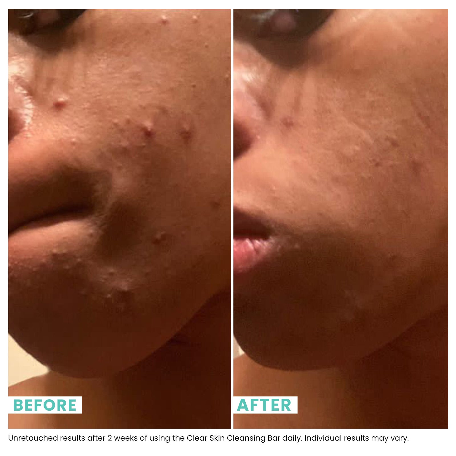Woman's face before and after using USRX Clean Skin Cleansing Bar treatment for clarifying skin