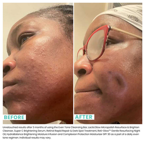 A woman's skin shown before using Urban Skin RX Lacticglow Micropolish Cleanser and after using it with visibly clearer skin