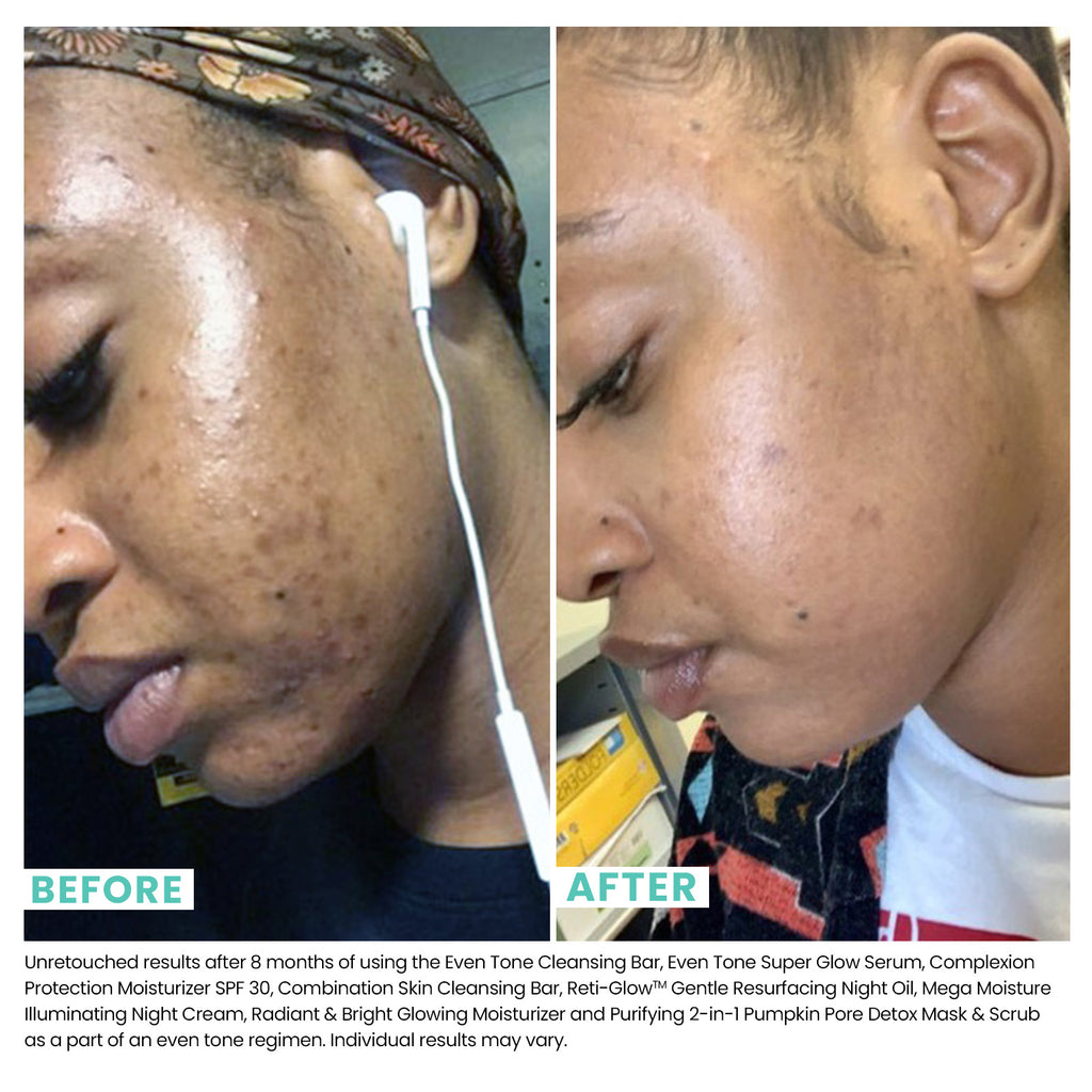 Comparison of woman's skin before and after using Urban Skin Rx Reti-Glow Gentle Resurfacing Night Oil on her face