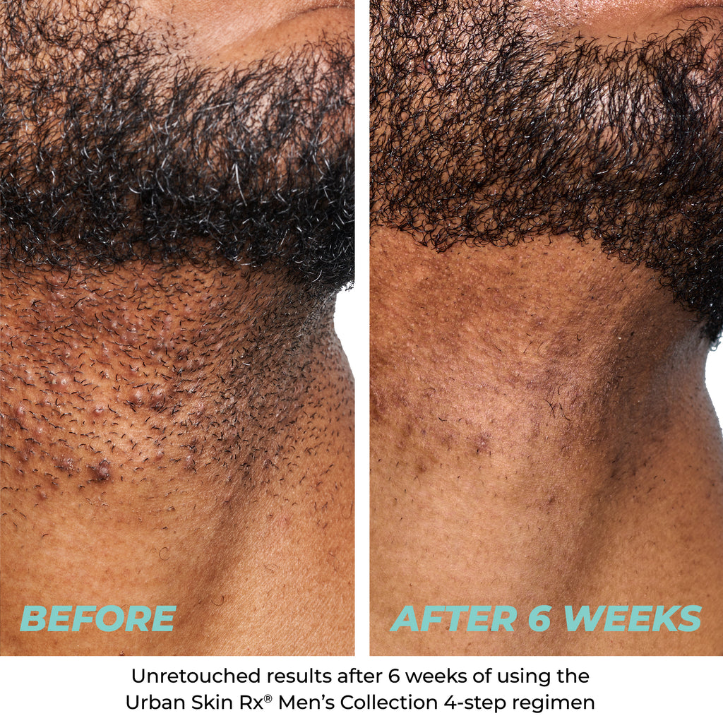 Man's skin before and after using Urban Skin RX Exfoliating Face Wash + Scrub with noticeably clearer skin